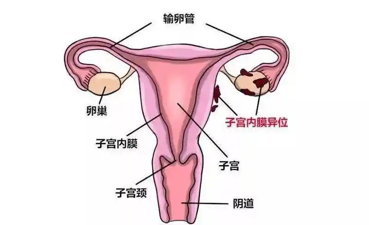 它如同顽皮的精灵,在子宫以外的部位悄悄生长,给女性带来无尽的痛苦与