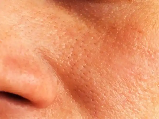 毛孔粗大具体症状