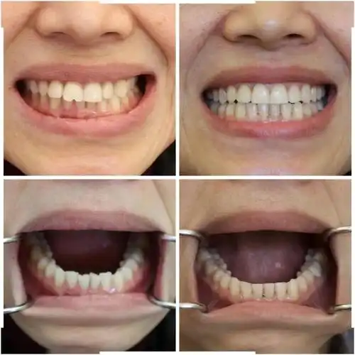 牙齿矫正前后对比实在太大啦!30多岁都不算晚!