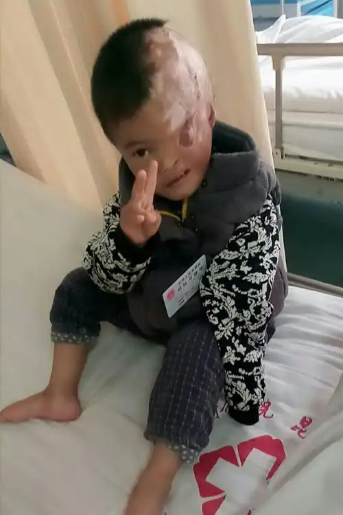 烧伤宝宝(小贵庚)求关注