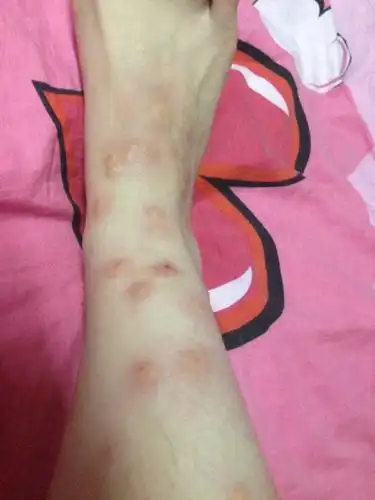 被跳蚤咬了 去医院开了很多药 也去药店买了很多药都感觉不管用 还是