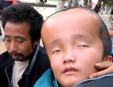 一个12岁的孩子,脑袋巨大无比,重量居然达到25公斤,超重的头部让孩子