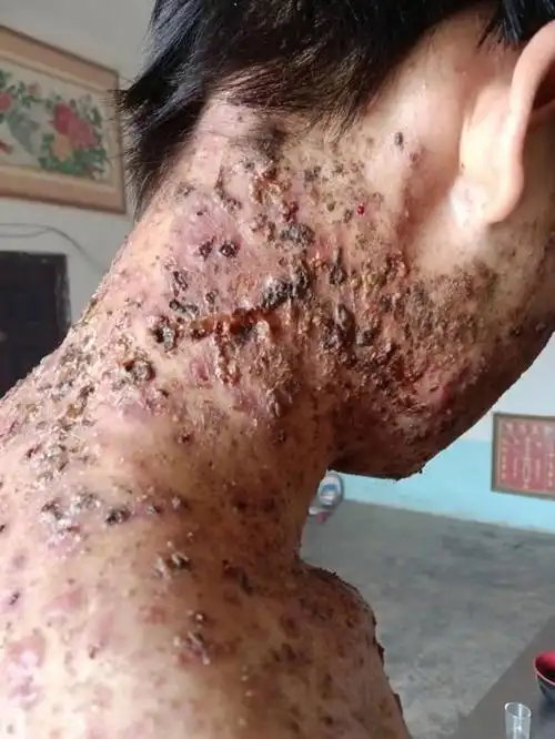 16岁小孩马拉色菌被中医治的毁容_马拉色菌毛囊炎-痤疮