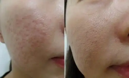 去痘印案例对比