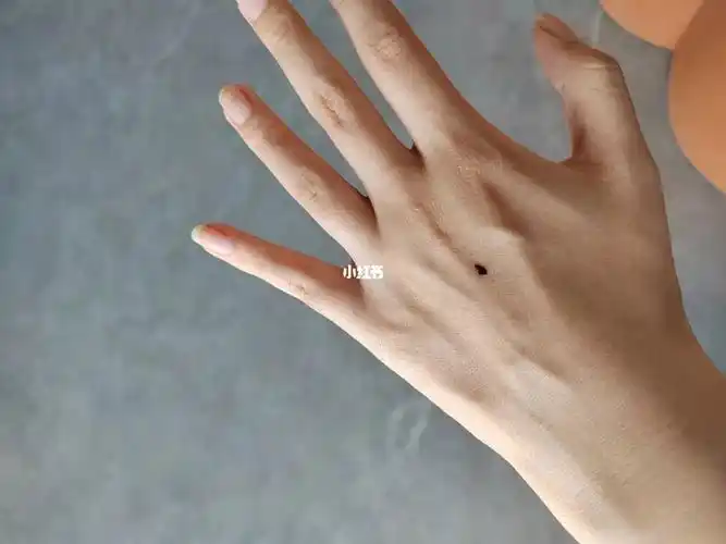 手上这颗更可疑最好切掉做个病理分析所以最后约了下周二把这三颗痣一