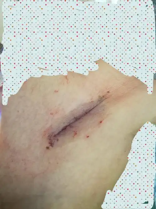 全胸腔镜下房间隔缺损修补术 - 好大夫在线