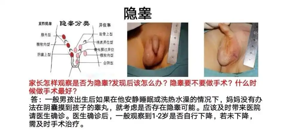 但如果体检没有在阴囊及腹股沟发现睾丸,就很有必要做一个阴囊部彩超