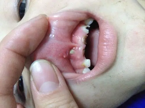 儿童蛀牙图片 ?