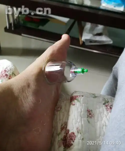 拔罐治脚气 一罐定乾坤