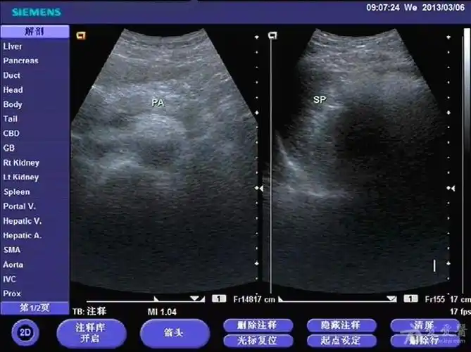 请教脂肪肝门静脉轻度扩张