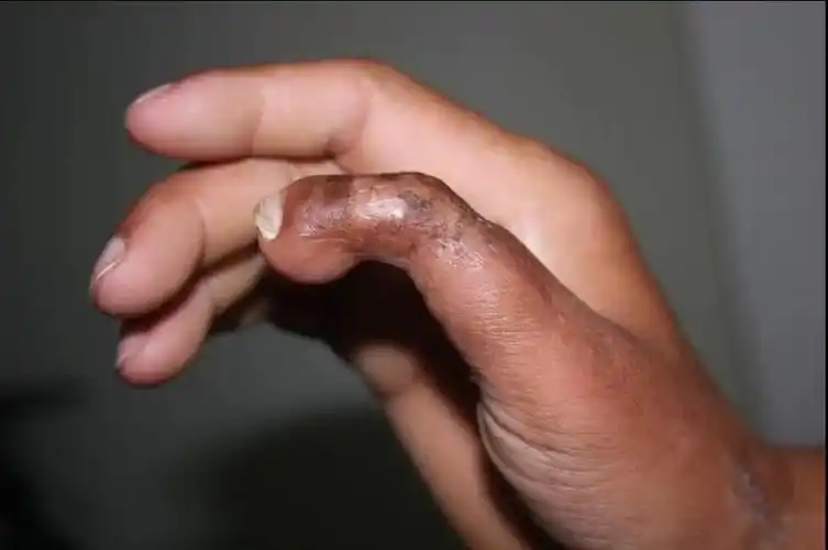 手指再造必须要牺牲脚趾当然不3d全形手指再造了解一下