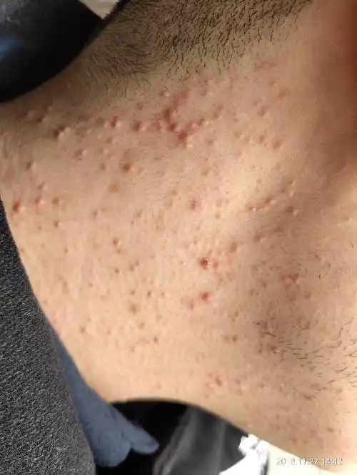 脖子上长了很多小痘痘,不太痒.这是什么原因?出现20天.