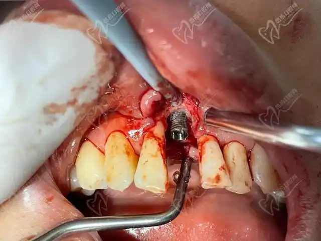 26岁做了种植牙我好后悔种牙后痛到绝望种的牙3年就坏了