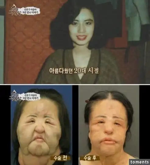 但千万别遭了罪还没讨好,下面就来看看这些整容失败的惊悚案例