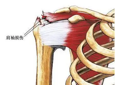 肩胛骨疼痛是什么原因如何区分肌肉劳损和肩周炎