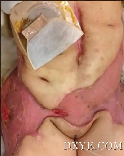 防不胜防:抽脂术引发肠穿孔一例