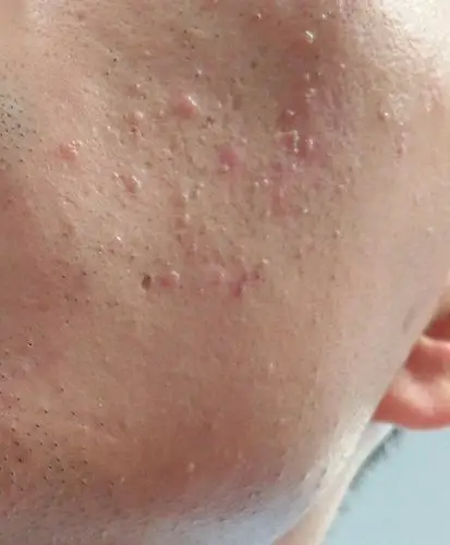 我最近一个月脸上起这种肉状的小疙瘩,不痛不痒的,看着难受,怎么回事