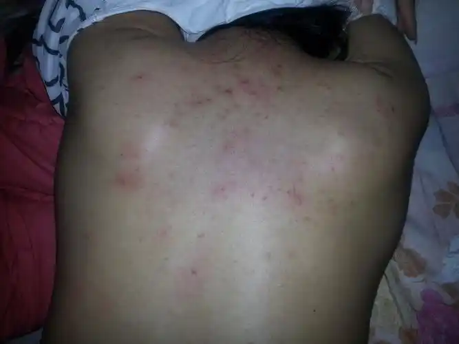 问:请专家看看后背皮肤怎么回事