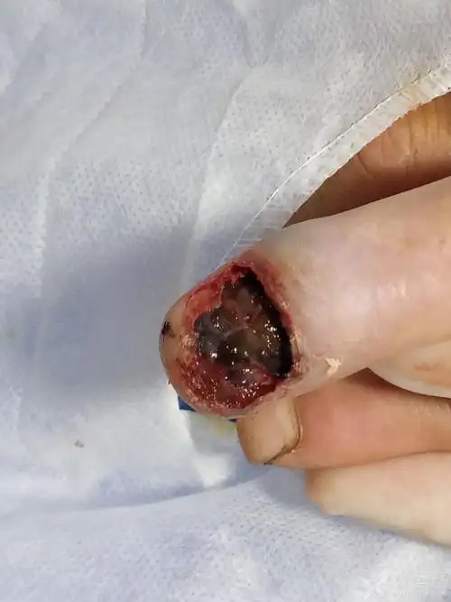 这个手指病变如何治疗.