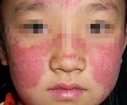 小儿红斑狼疮有哪些特点