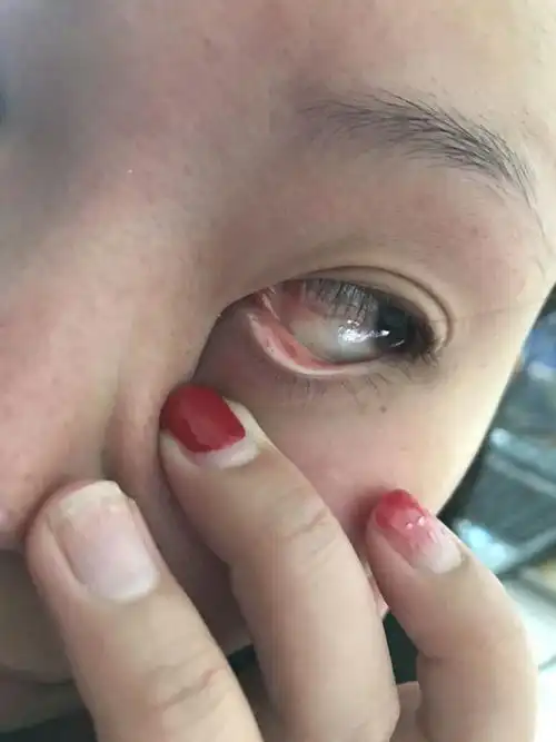 之前去医院眼是结膜炎干眼症.