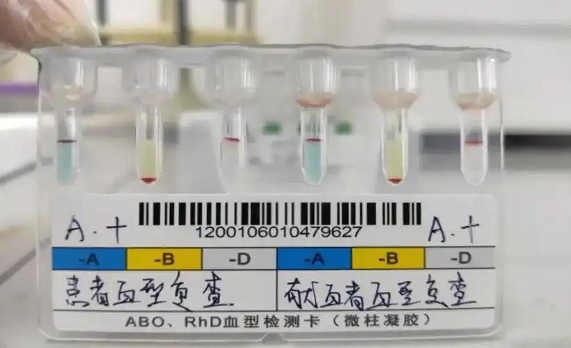 图2 交叉配血首查结果及复查结果回科室后询问了值班老师具体操作过程