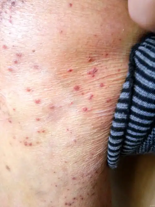 今天的病人,皮疹不痛不痒 - 皮肤及性传播疾病讨论版 - 爱爱医医学