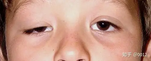 重症肌无力,影响你步入幸福生活的一道坎