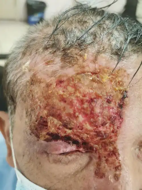 带状疱疹_症状表现_治疗方式 - 好大夫在线