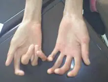 马凡氏综合征又名蜘蛛指(趾)  综合征,属于一种先天性遗传性结缔组织