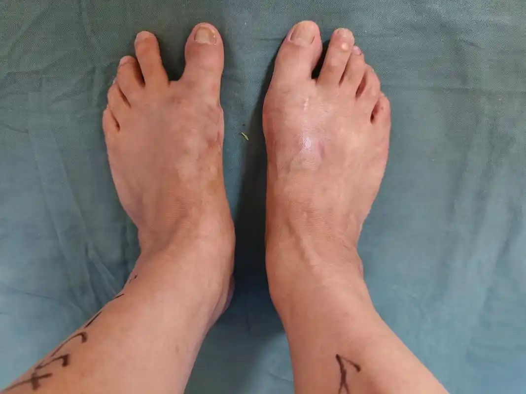 拇外翻术后并发症～～拇内翻#拇外翻