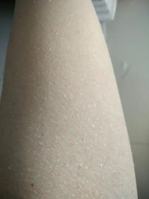 泡温泉后全身就严重干燥爆皮,怎么办