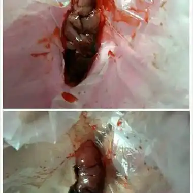 一般前两天吃米非司酮片,第三天早上吃味噌,会出现阴道流血,孕囊排出