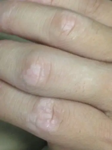 问:手痒,脱皮,指节发白…这种情况持续一阵了…想知道这是什么病,需要