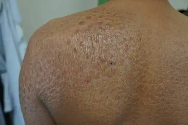 成年鱼鳞病要警惕恶性肿瘤 (原创)