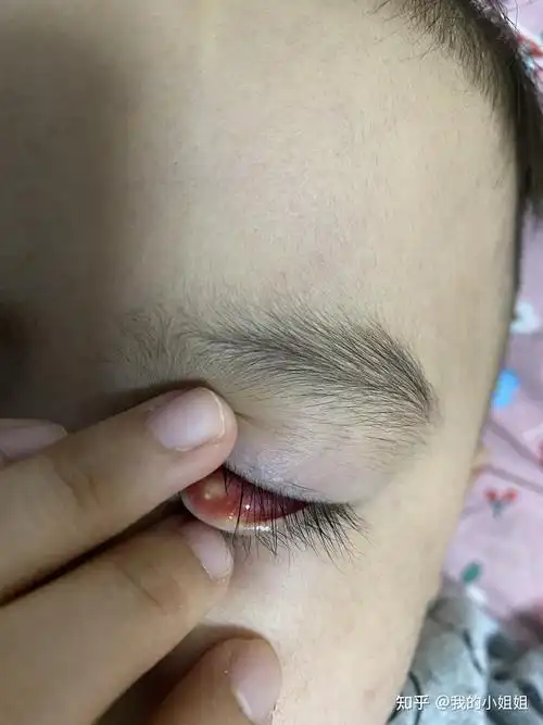 三岁宝宝霰粒肿中医治疗之路