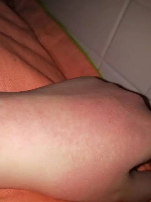 手背起红,还有点辣 和痒,是什么原因?
