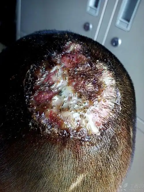 【病例讨论】这个头皮是肿么回事?请教园内大侠指点 [病例帖]