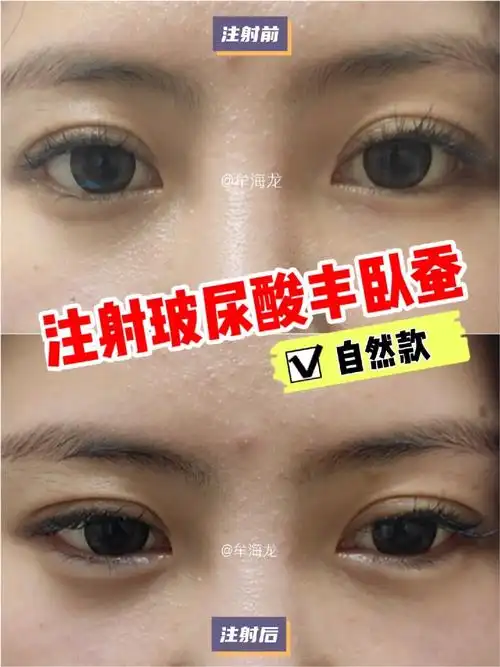 注射玻尿酸丰卧蚕填充后即刻对比