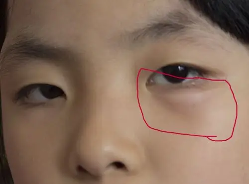 问:孩子的眼睛下眼部突然出现微红的肿块,怎么回事?如何治疗?