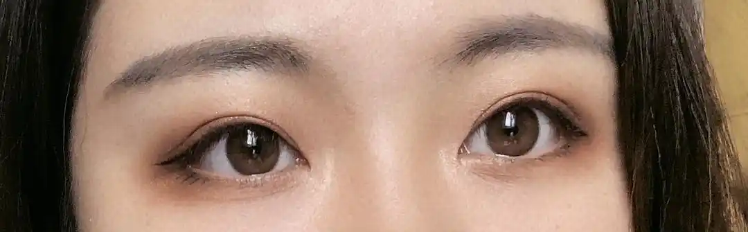 本人是左眼重度上睑下垂 右眼轻度 图片上是第二次做完手术的效果