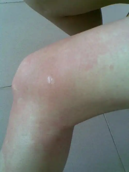 季节性皮肤过敏怎么办