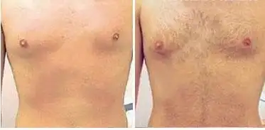 【科大植发】没有胸毛怎么办呢?