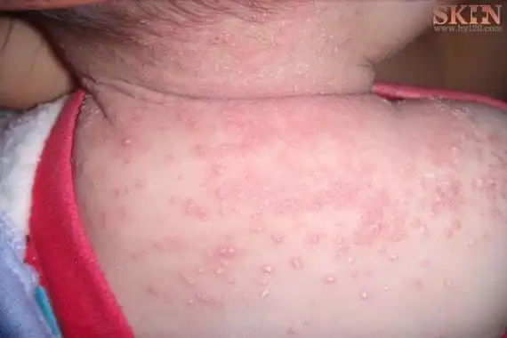 婴儿湿疹长什么样图片和症状 ( 婴儿湿疹长什么样图片)