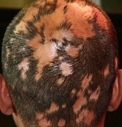 脑袋头发掉一大片,这是怎么了?几个方法帮你搞定