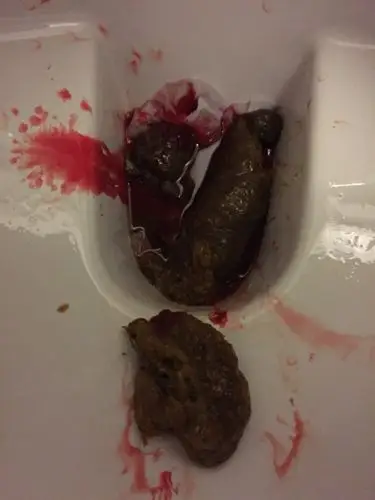 不好意思给大家看这些恶心的图片.