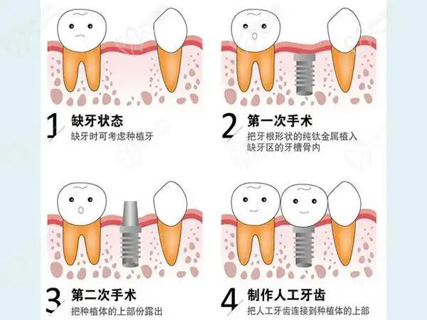 种植牙过程示意图