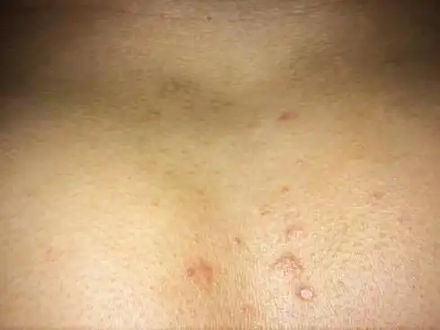 艾滋病水泡特点图片