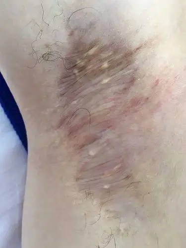 术前诊断患者情况:修复腋臭疤痕,可见患者手术后明显_圈子-新氧美容