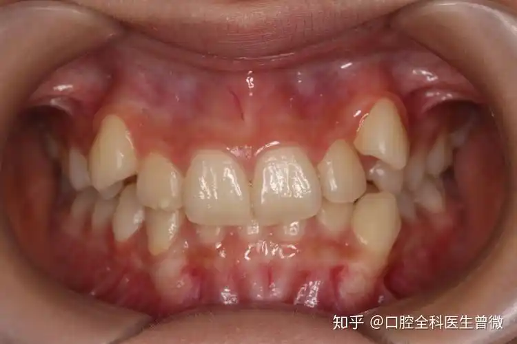 可以看到她的牙列非常拥挤,前牙错位,虎牙上翘,中线不齐,严重影响咬合